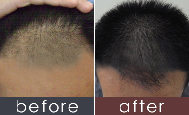 达到最终效果时间 术后3-6个月 效果维持时间 种植的毛发效果持久