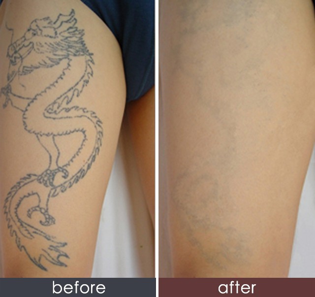 哈尔滨激光洗纹身 挥别过去 做崭新的自己 效果自然彻底