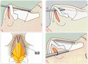 范志宏医生技术特点 上海宏仁范主任采用潜行分离将鼻翼软骨,侧鼻软骨