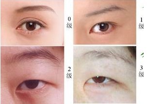 3,一般来说,通过开眼角手术可以使眼睛长度增加3-5mm,恢复般可以